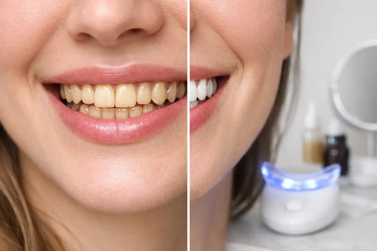 Teeth Whitening Before and After at Home